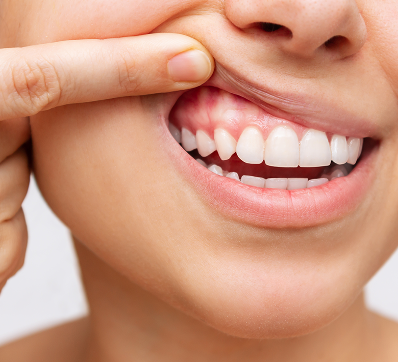 PERIODONCIA. BRITO_GALLO. CLÍNICA DENTAL EN OVIEDO